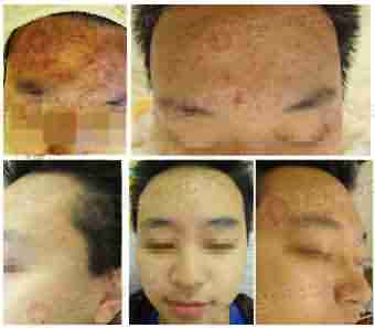 痘友一句666,北大皮肤科主任懵了-lni