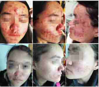 痘友一句666,北大皮肤科主任懵了-lni