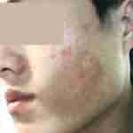 日光皮炎治疗一定要谨慎-lni