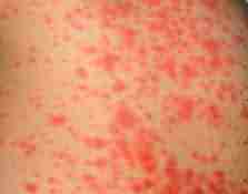 兰州北大巧治各类皮炎-lni