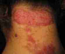 兰州北大巧治各类皮炎-lni