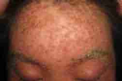 兰州北大巧治各类皮炎-lni