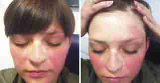 兰州北大巧治各类皮炎-lni