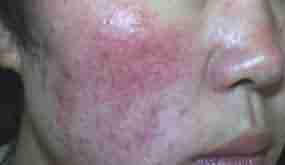 ���ݱ������θ���Ƥ��-lni