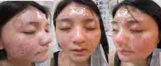 青春痘治不好,花一块钱都不值-lni