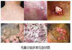 了解毛囊炎的病因 才能对症下药-lni