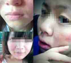 了解皮肤过敏症状 及时治疗效果好-lni