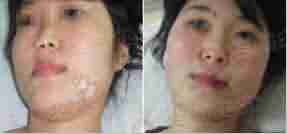 白癜风危害大 治疗及时是关键-lni