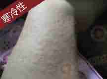 荨麻疹危害大,了解类型对症分型治疗-lni