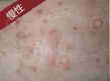 湿疹反复发作,北大治疗有妙招-lni