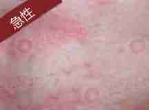 荨麻疹危害大,了解类型对症分型治疗-lni