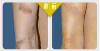 微晶疤痕修复——祛疤不留痕迹-lni