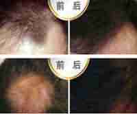 兰州治疗脱发正规好的专科-lni