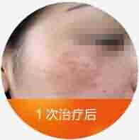 Q色素激光结合中药御方倒膜-lni