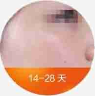 Q色素激光结合中药御方倒膜-lni