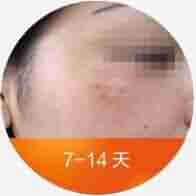 Q色素激光结合中药御方倒膜-lni