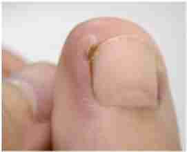 【病因】了解甲沟炎的病因-lni