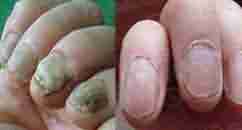 【灰指甲】汉方渗透软化杀菌疗法-lni