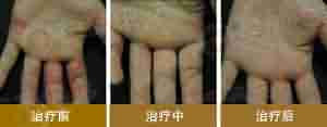 【湿疹】中西医生物脱敏渗透疗法 快速根治技术-lni
