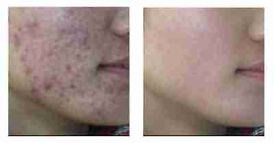 兰州北大快速祛痘 省钱更省心-lni