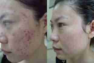 兰州北大快速祛痘 省钱更省心-lni