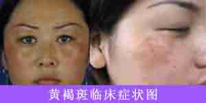 祛除黄褐斑 选兰州北大-lni