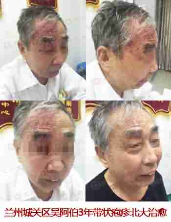 带状疱疹是怎么回事?该怎么治疗-lni