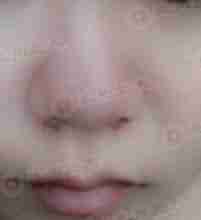 治疗酒糟鼻什么方法效果好?-lni