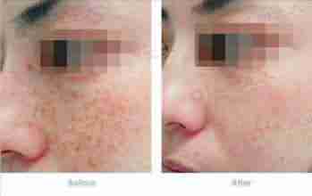 【黄褐斑】OS医学分层祛斑-lni