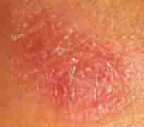 兰州北大中西医结合治疗体股癣-lni