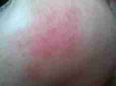 【解密】皮肤过敏的原因有哪些-lni