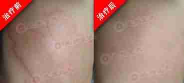 【荨麻疹】生物波止痒脱敏疗法-lni