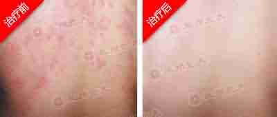 【荨麻疹】生物波止痒脱敏疗法-lni