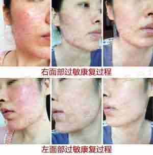 【费用】北大治疗皮肤过敏多少钱-lni