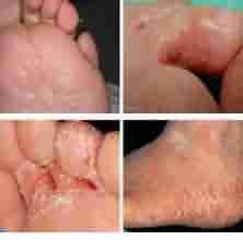 【症状】医生解读手足癣五大症状-lni