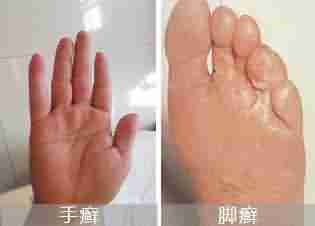 警惕!手足癣的易传染-lni
