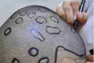 【植发】无痕植发技术-lni