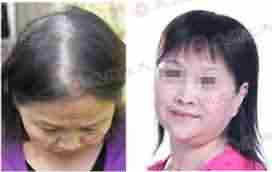 【植发】无痕植发技术-lni