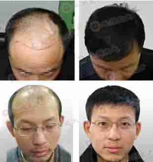 【植发】无痕植发技术-lni