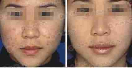 脸上长了粉刺怎么办-lni