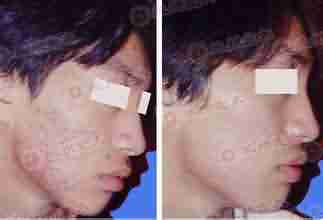 脸上长了粉刺怎么办-lni