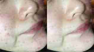 脸上长了粉刺怎么办-lni