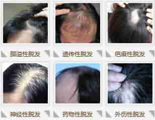 头发掉的厉害怎么办?-lni