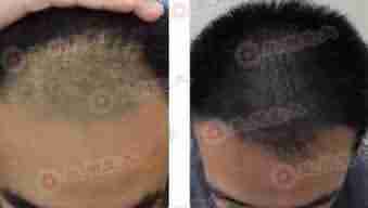 头发掉的厉害怎么办?-lni