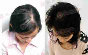 头发掉的厉害怎么办?-lni