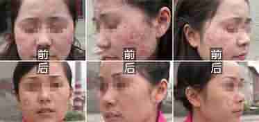 【扁平疣】中西结合净毒祛疣疗法-lni