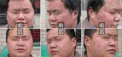 【扁平疣】中西结合净毒祛疣疗法-lni