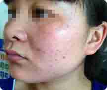 兰州祛痘医生详解长痘痘的原因-lni