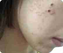 兰州祛痘医生详解长痘痘的原因-lni