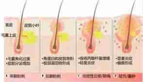 北大倡导科学祛痘 让青春不再有“痘”留-lni